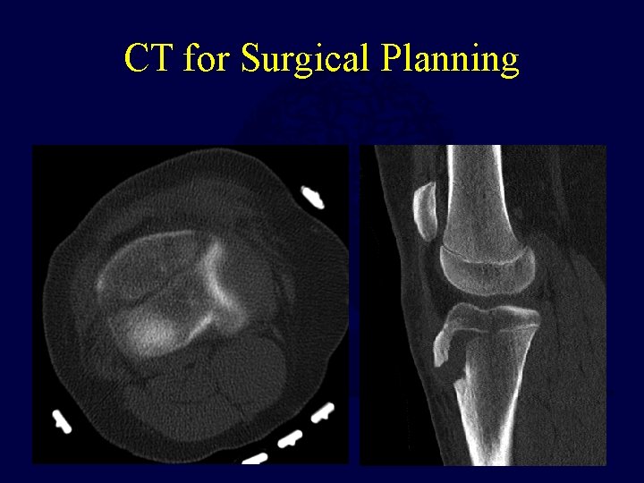 CT for Surgical Planning 