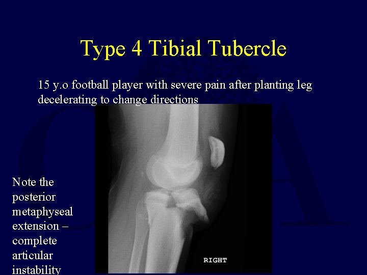 Type 4 Tibial Tubercle 15 y. o football player with severe pain after planting