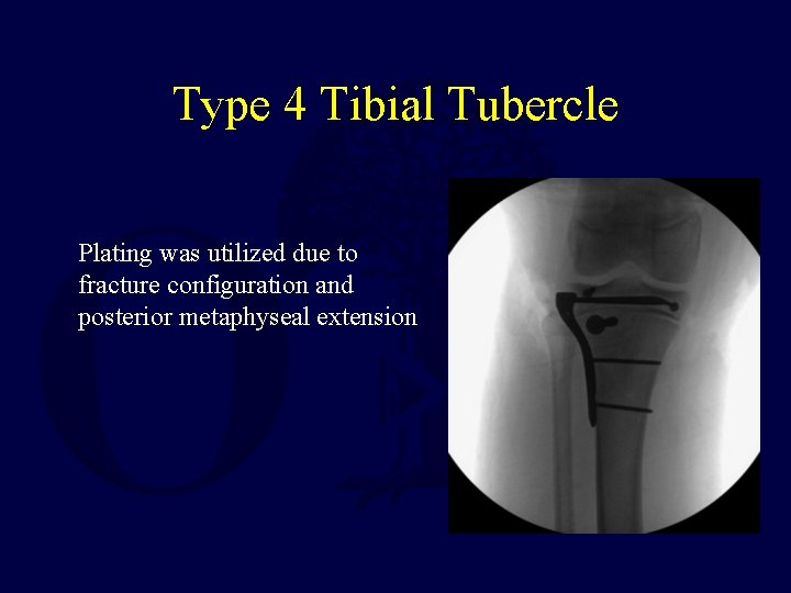 Type 4 Tibial Tubercle Plating was utilized due to fracture configuration and posterior metaphyseal