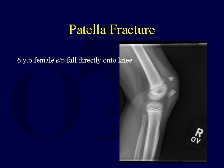 Patella Fracture 6 y. o female s/p fall directly onto knee 