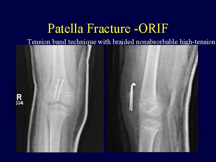 Patella Fracture -ORIF Tension band technique with braided nonabsorbable high-tension 