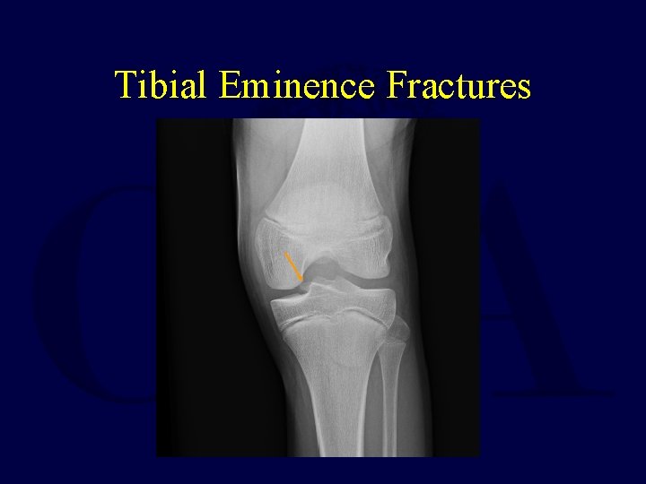 Tibial Eminence Fractures 