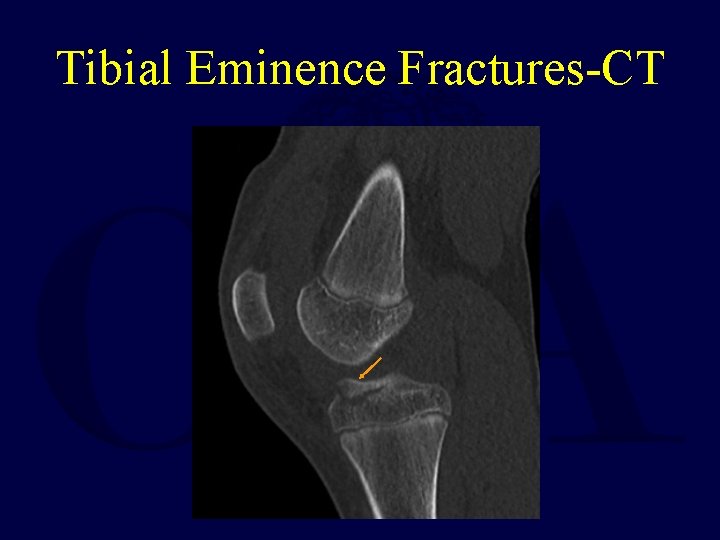 Tibial Eminence Fractures-CT 