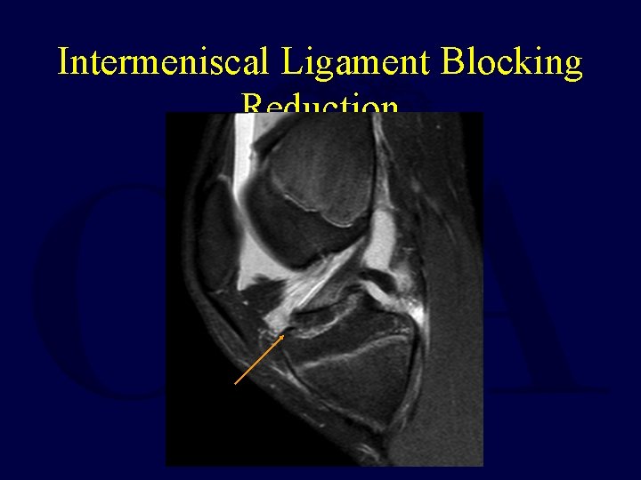 Intermeniscal Ligament Blocking Reduction 