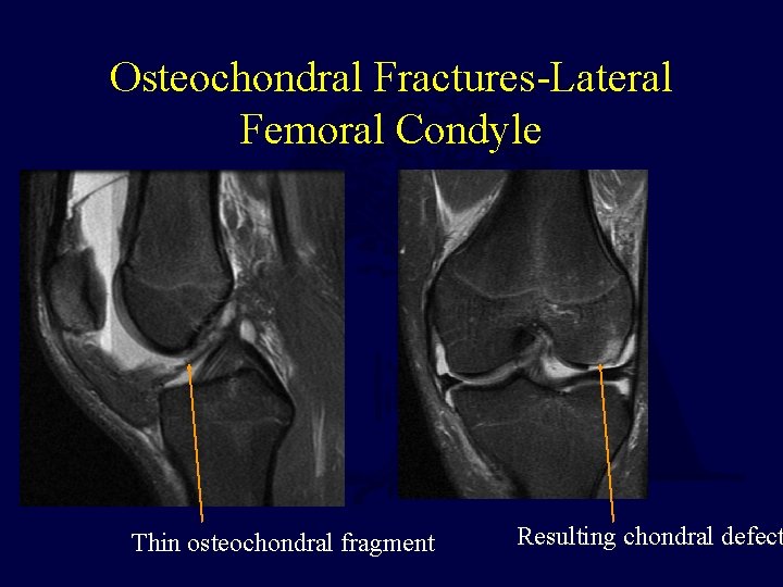 Osteochondral Fractures-Lateral Femoral Condyle Thin osteochondral fragment Resulting chondral defect 