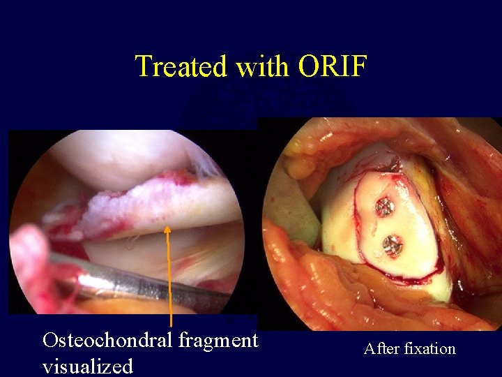 Treated with ORIF Osteochondral fragment visualized After fixation 