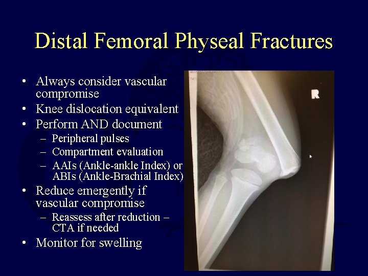 Distal Femoral Physeal Fractures • Always consider vascular compromise • Knee dislocation equivalent •