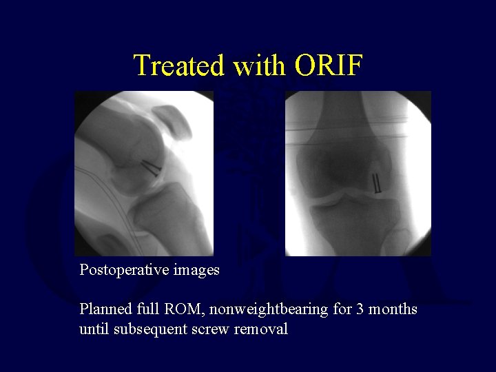 Treated with ORIF Postoperative images Planned full ROM, nonweightbearing for 3 months until subsequent