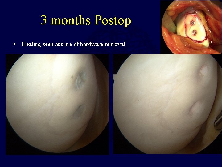 3 months Postop • Healing seen at time of hardware removal 