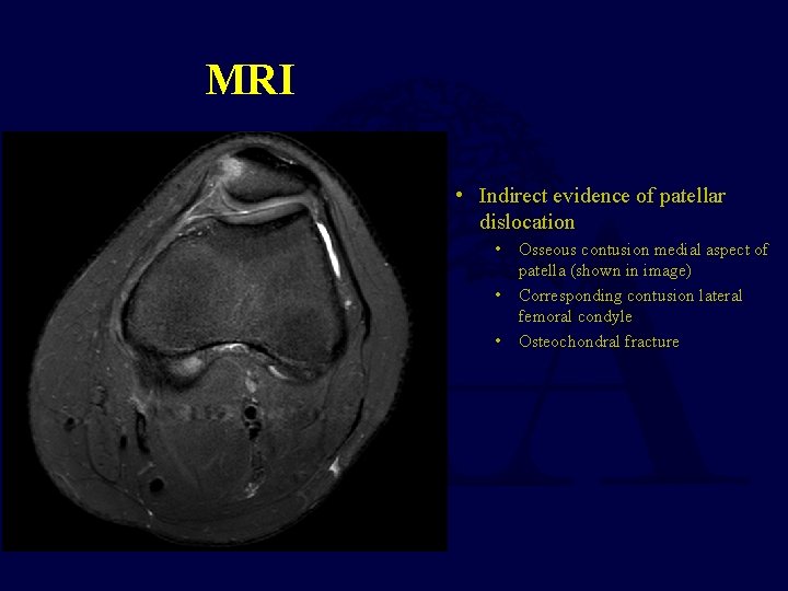 MRI • Indirect evidence of patellar dislocation • • • Osseous contusion medial aspect