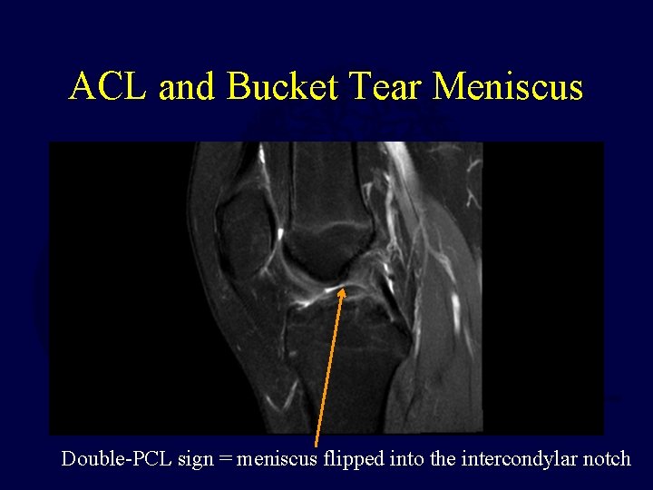 ACL and Bucket Tear Meniscus Double-PCL sign = meniscus flipped into the intercondylar notch