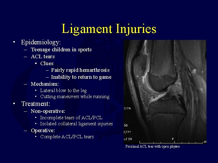 Ligament Injuries • Epidemiology: – Teenage children in sports – ACL tears • Clues