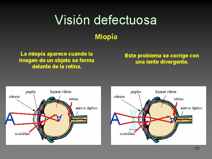 Visión defectuosa Miopía La miopía aparece cuando la imagen de un objeto se forma