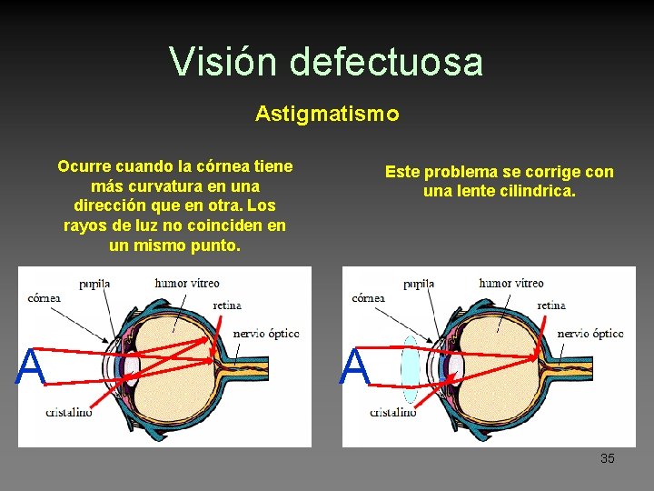 Visión defectuosa Astigmatismo Ocurre cuando la córnea tiene más curvatura en una dirección que