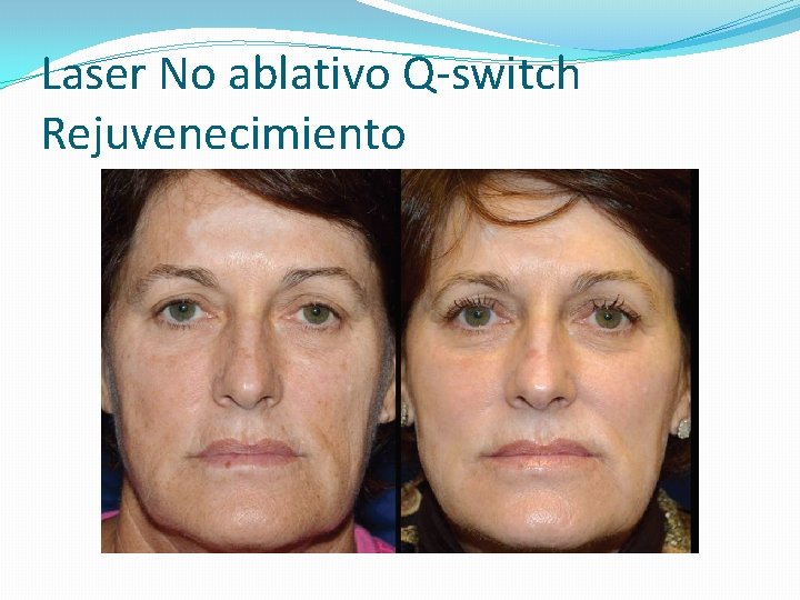 Laser No ablativo Q-switch Rejuvenecimiento 