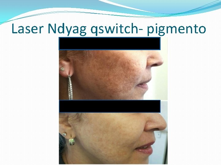 Laser Ndyag qswitch- pigmento Laser Ndyag qswitch- pigmento