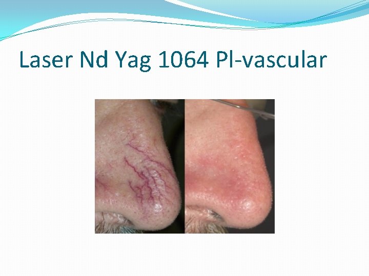 Laser Nd Yag 1064 Pl-vascular 