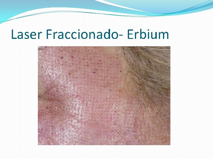 Laser Fraccionado- Erbium 