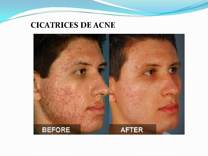 CICATRICES DE ACNE 