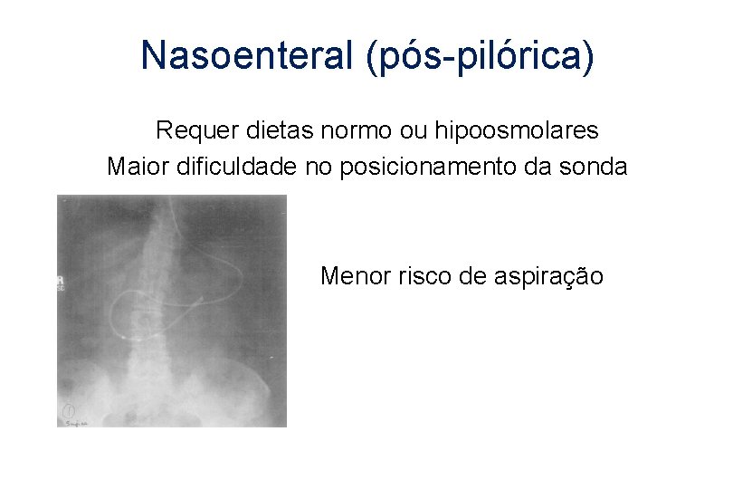 Nasoenteral (pós-pilórica) Requer dietas normo ou hipoosmolares Maior dificuldade no posicionamento da sonda Menor