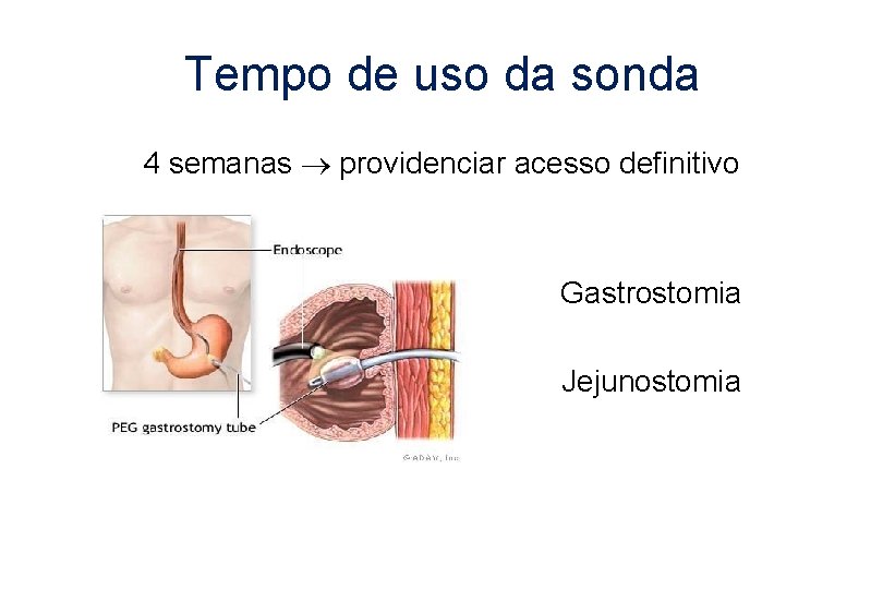 Tempo de uso da sonda 4 semanas providenciar acesso definitivo Gastrostomia Jejunostomia 