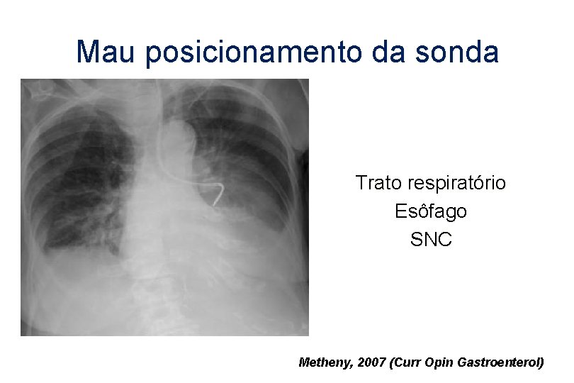 Mau posicionamento da sonda Trato respiratório Esôfago SNC Metheny, 2007 (Curr Opin Gastroenterol) 