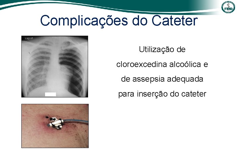 Complicações do Cateter Utilização de cloroexcedina alcoólica e de assepsia adequada para inserção do