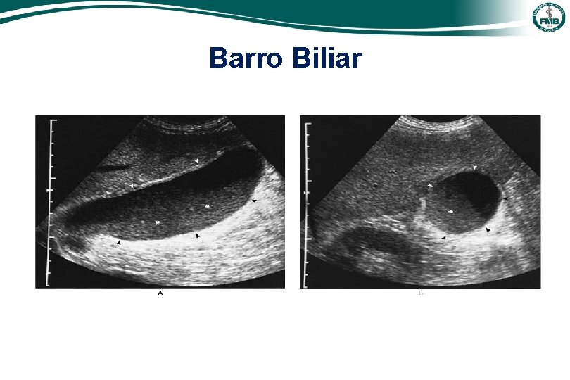 Barro Biliar 