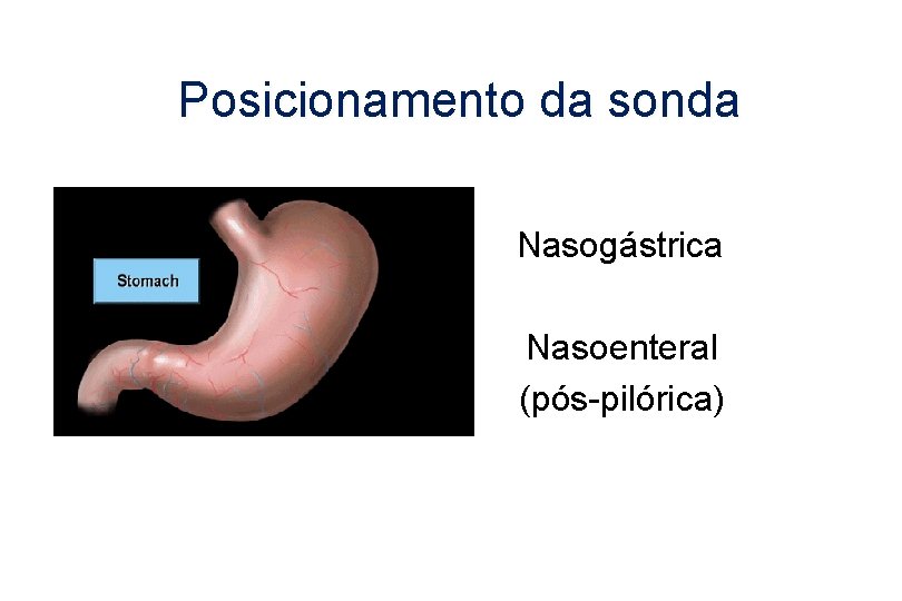 Posicionamento da sonda Nasogástrica Nasoenteral (pós-pilórica) 