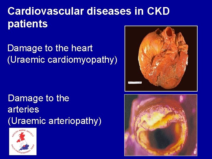 Cardiovascular diseases in CKD patients Damage to the heart (Uraemic cardiomyopathy) Damage to the