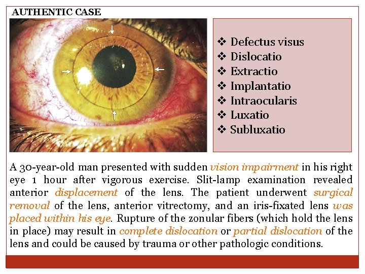 AUTHENTIC CASE v Defectus visus v Dislocatio v Extractio v Implantatio v Intraocularis v AUTHENTIC CASE v Defectus visus v Dislocatio v Extractio v Implantatio v Intraocularis v