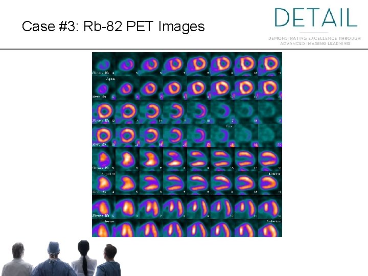 Case #3: Rb-82 PET Images Case courtesy of Jim O’Donnell, MD, University Hospitals Health