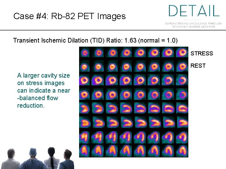 Case #4: Rb-82 PET Images Transient Ischemic Dilation (TID) Ratio: 1. 63 (normal =