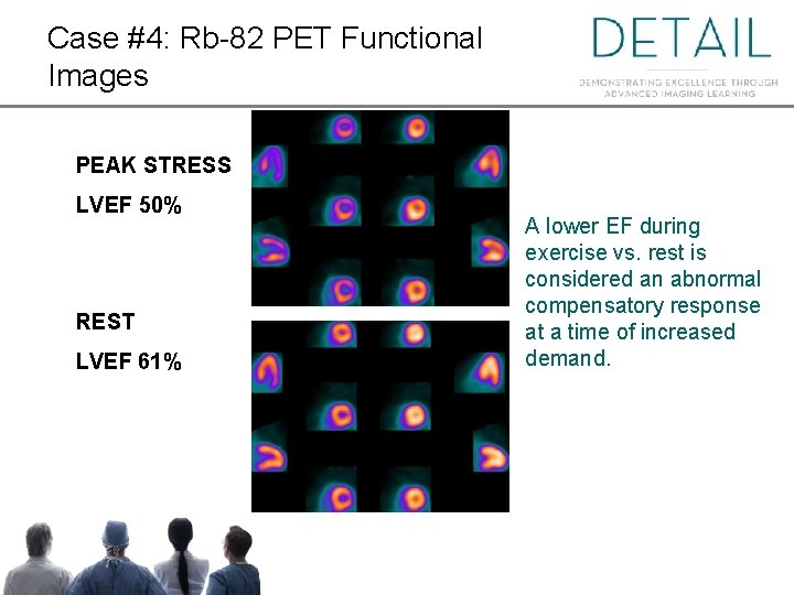 Case #4: Rb-82 PET Functional Images PEAK STRESS LVEF 50% REST LVEF 61% A