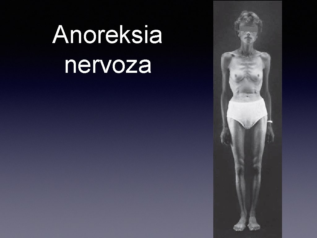 Anoreksia nervoza 