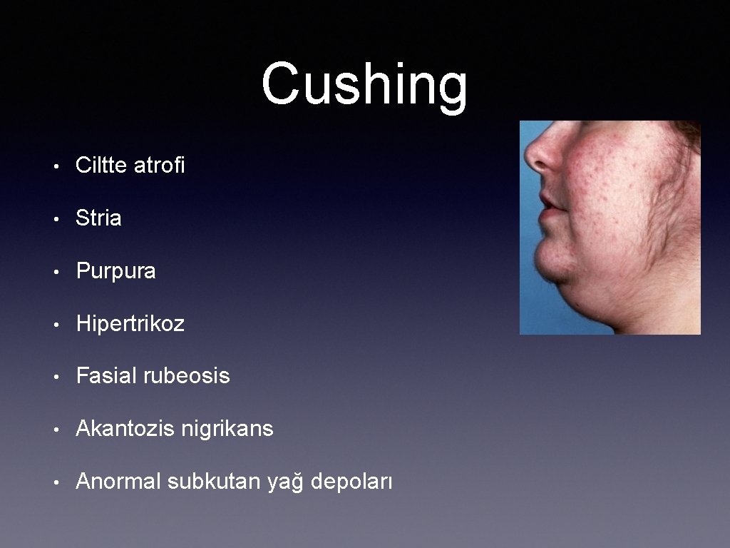 Cushing • Ciltte atrofi • Stria • Purpura • Hipertrikoz • Fasial rubeosis •