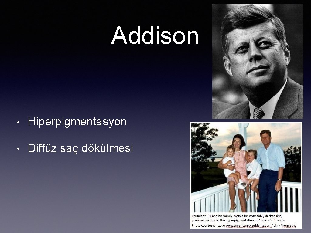 Addison • Hiperpigmentasyon • Diffüz saç dökülmesi 