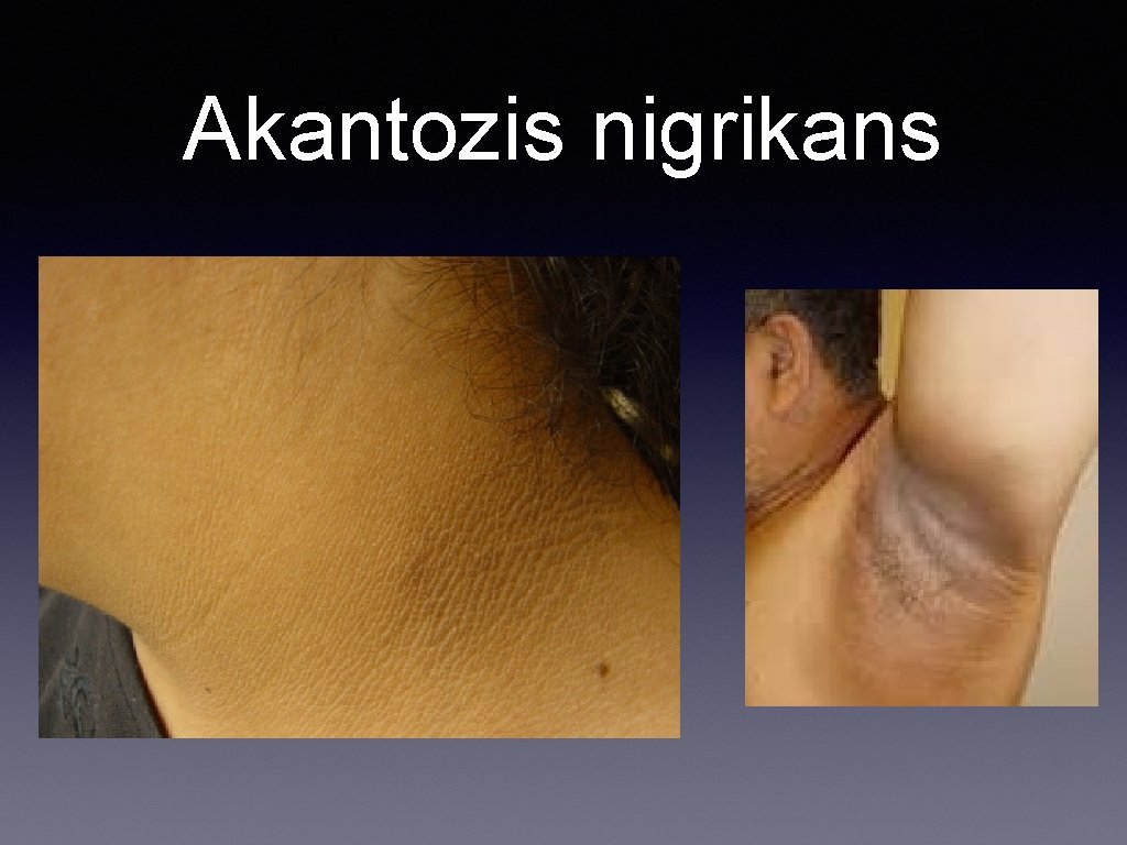 Akantozis nigrikans 