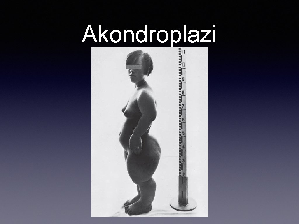 Akondroplazi 