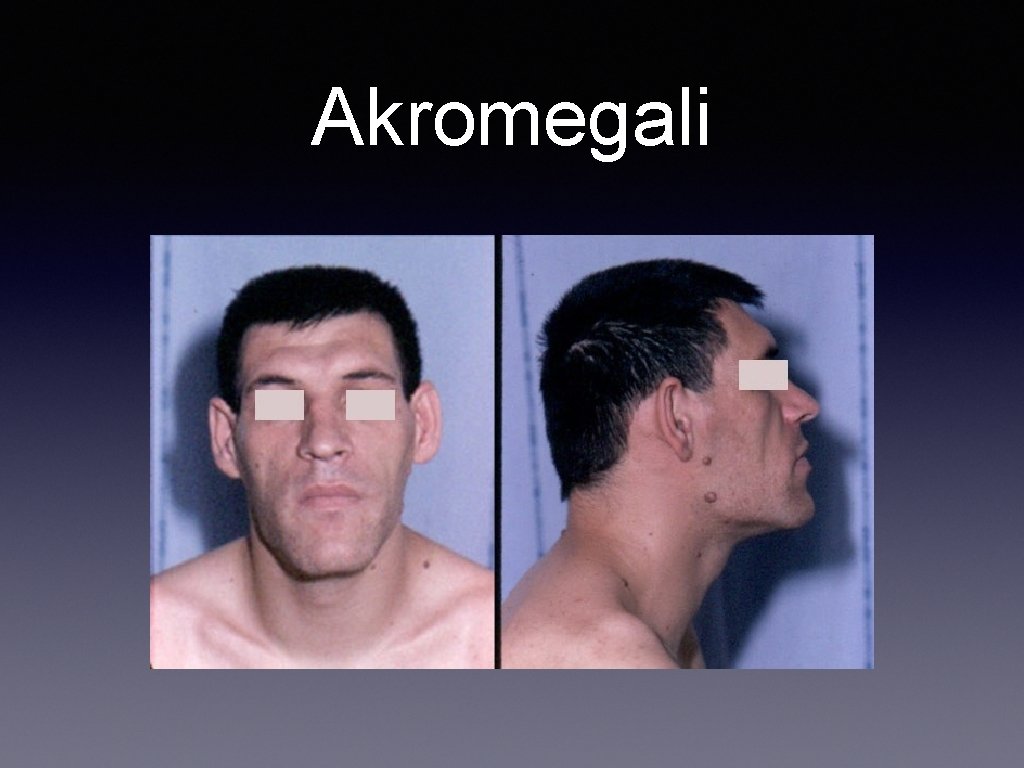 Akromegali 