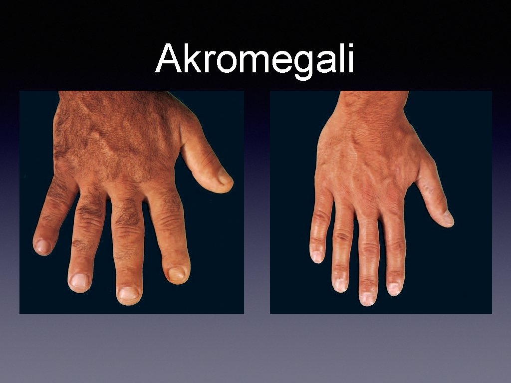 Akromegali 