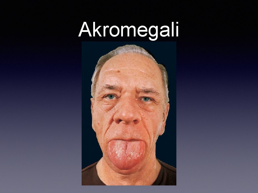 Akromegali 