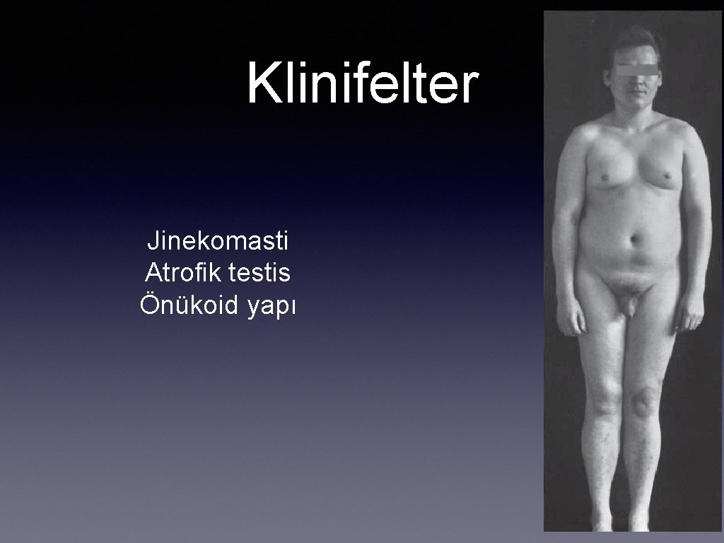 Klinifelter Jinekomasti Atrofik testis Önükoid yapı 