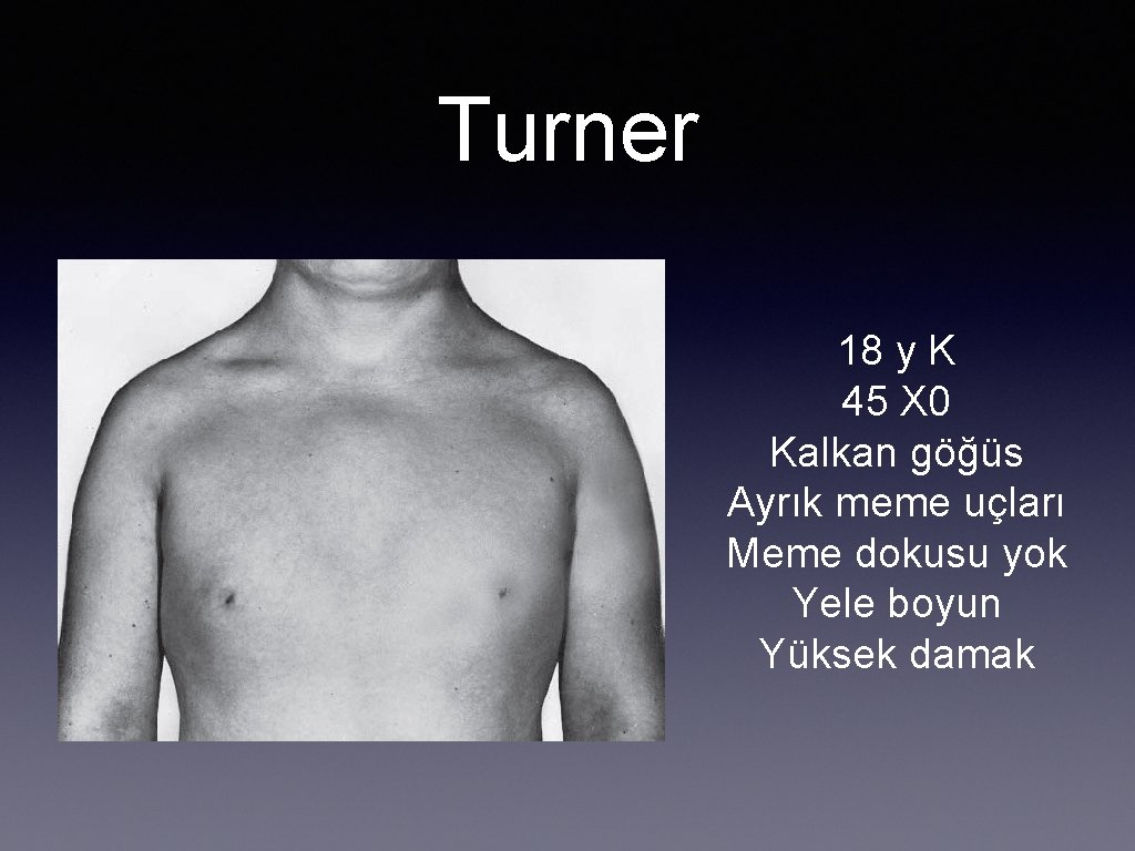 Turner 18 y K 45 X 0 Kalkan göğüs Ayrık meme uçları Meme dokusu