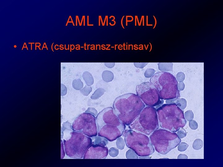AML M 3 (PML) • ATRA (csupa-transz-retinsav) 
