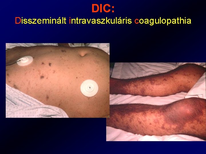 DIC: Disszeminált intravaszkuláris coagulopathia 