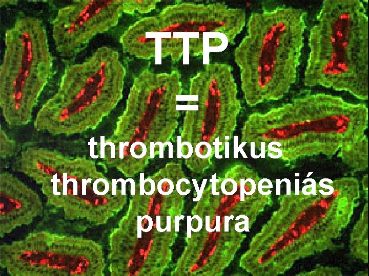 TTP = thrombotikus thrombocytopeniás purpura 