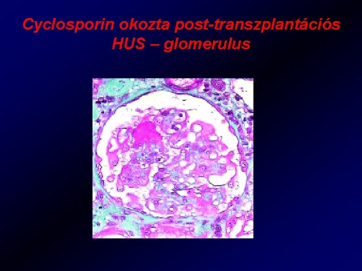 Cyclosporin okozta post-transzplantációs HUS – glomerulus 