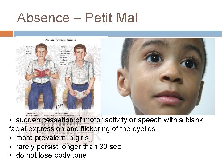 Absence – Petit Mal • sudden cessation of motor activity or speech with a