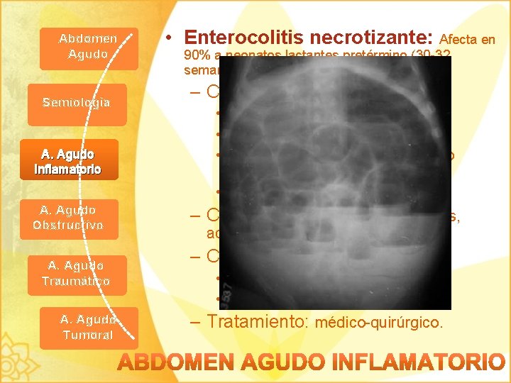 Abdomen Agudo Semiología A. Agudo Inflamatorio A. Agudo Obstructivo A. Agudo Traumático A. Agudo